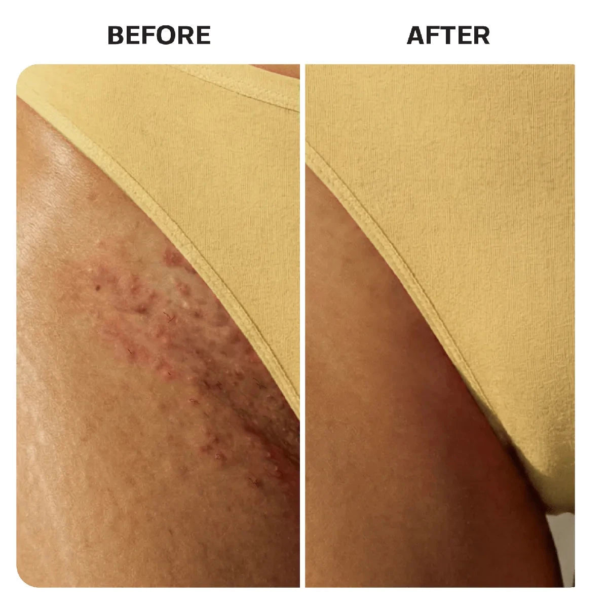 Ingrown Hair Complete Extraction Kit Base Laboratories 