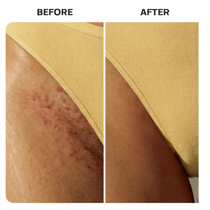 Ingrown Hair Complete Extraction Kit Base Laboratories 