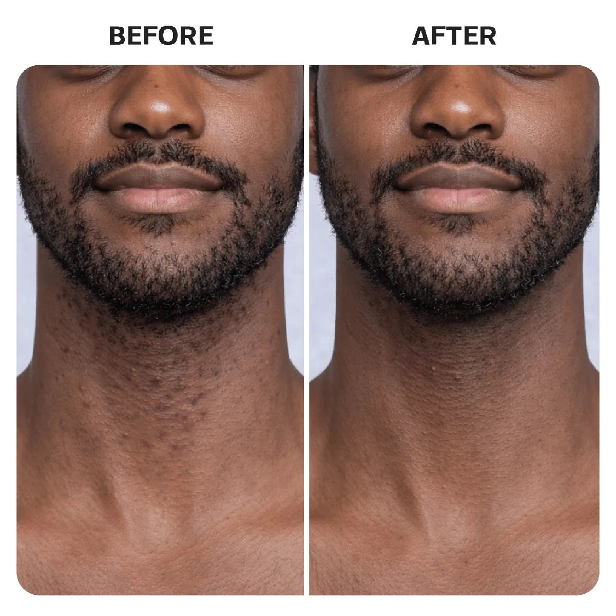 Ingrown Hair Complete Extraction Kit Base Laboratories 