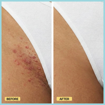 Ingrown Hair Reset Duo Base Laboratories 