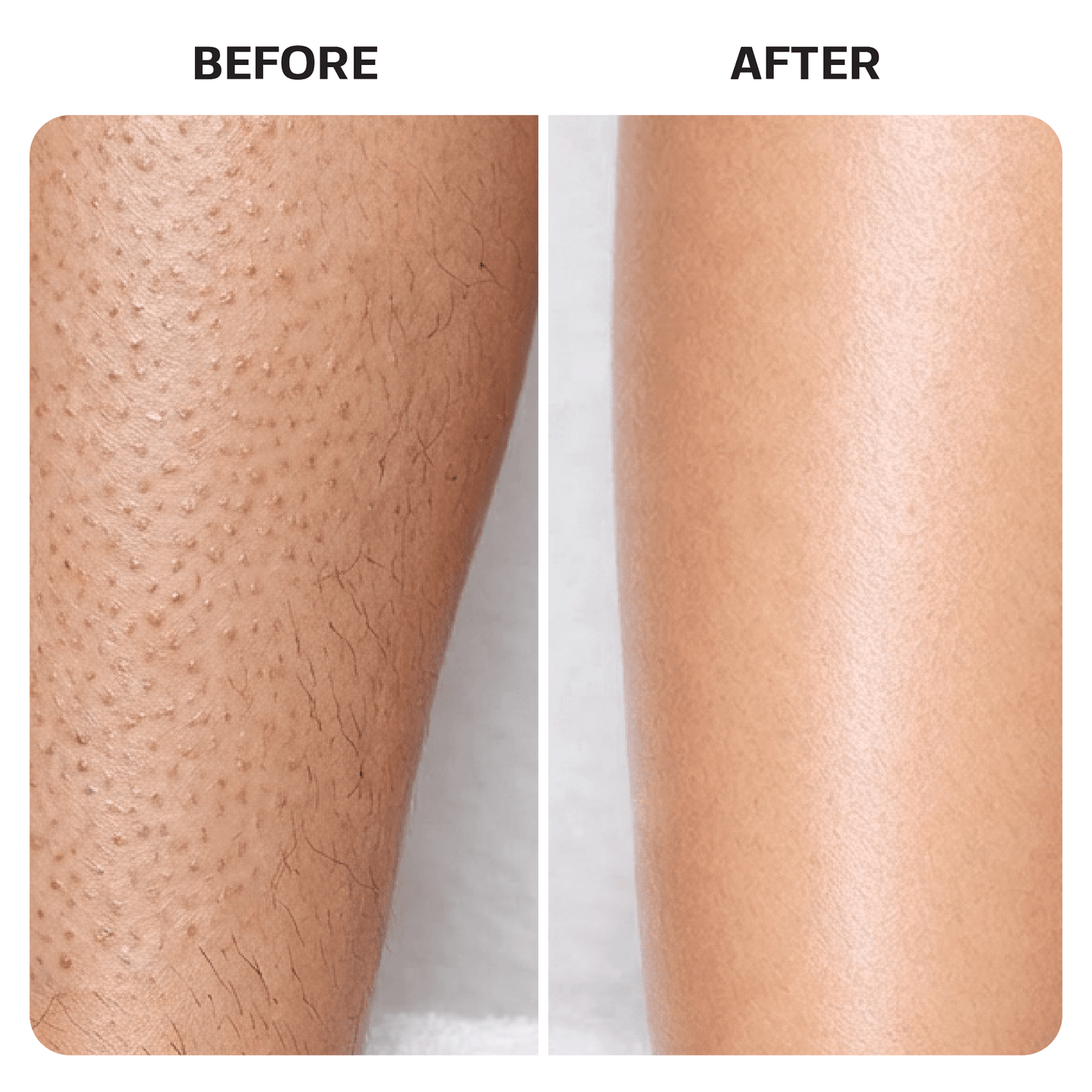 Ingrown Hair Roller Serum ingrown Base Laboratories 