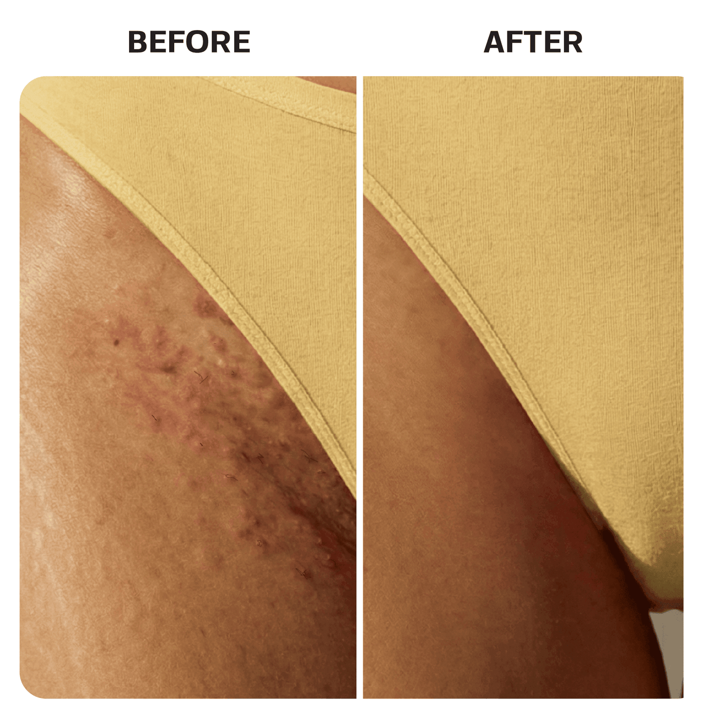 Ingrown Hair Roller Serum ingrown Base Laboratories 