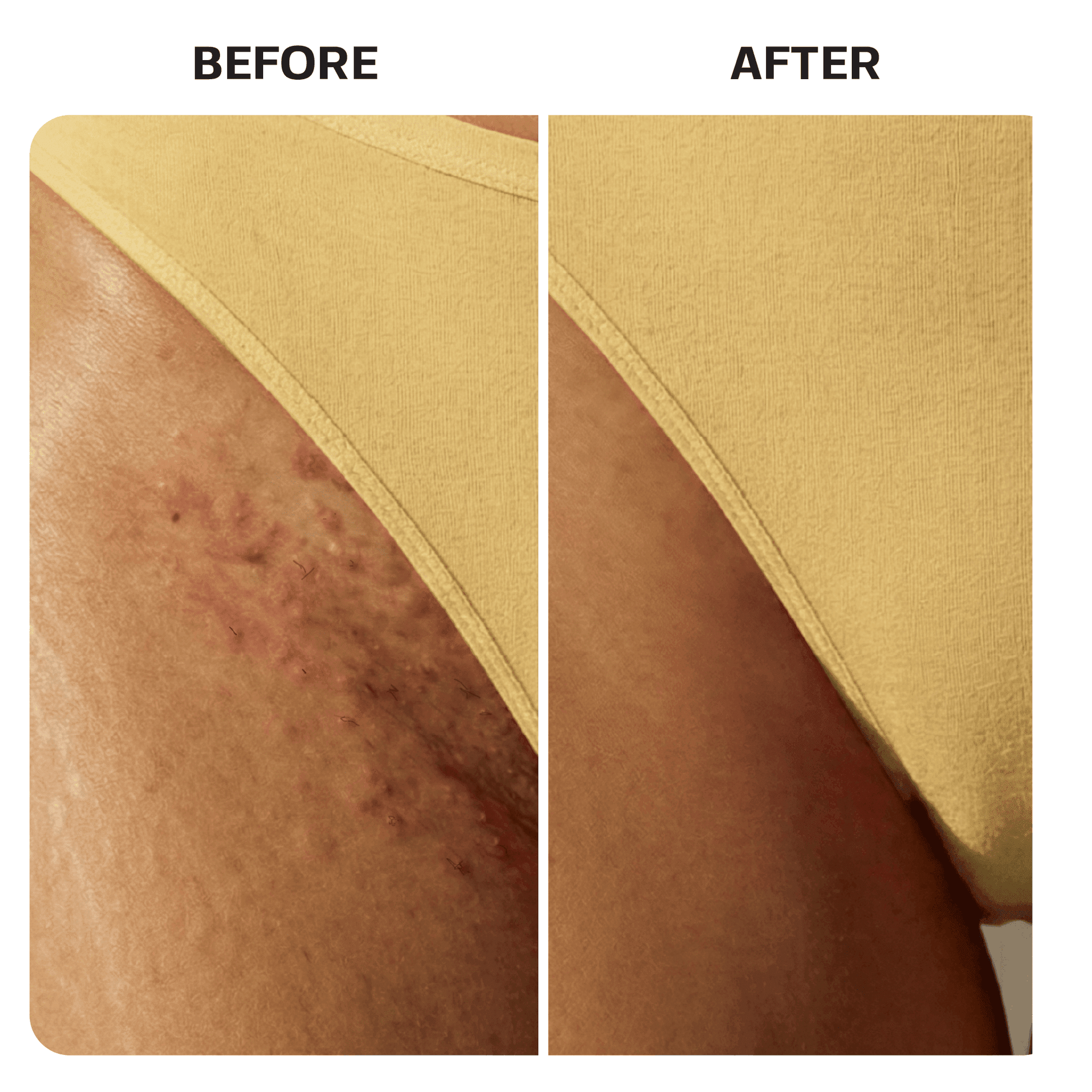 Ingrown Hair Roller Serum ingrown Base Laboratories 