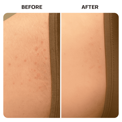 Ingrown Hair Roller Serum ingrown Base Laboratories 