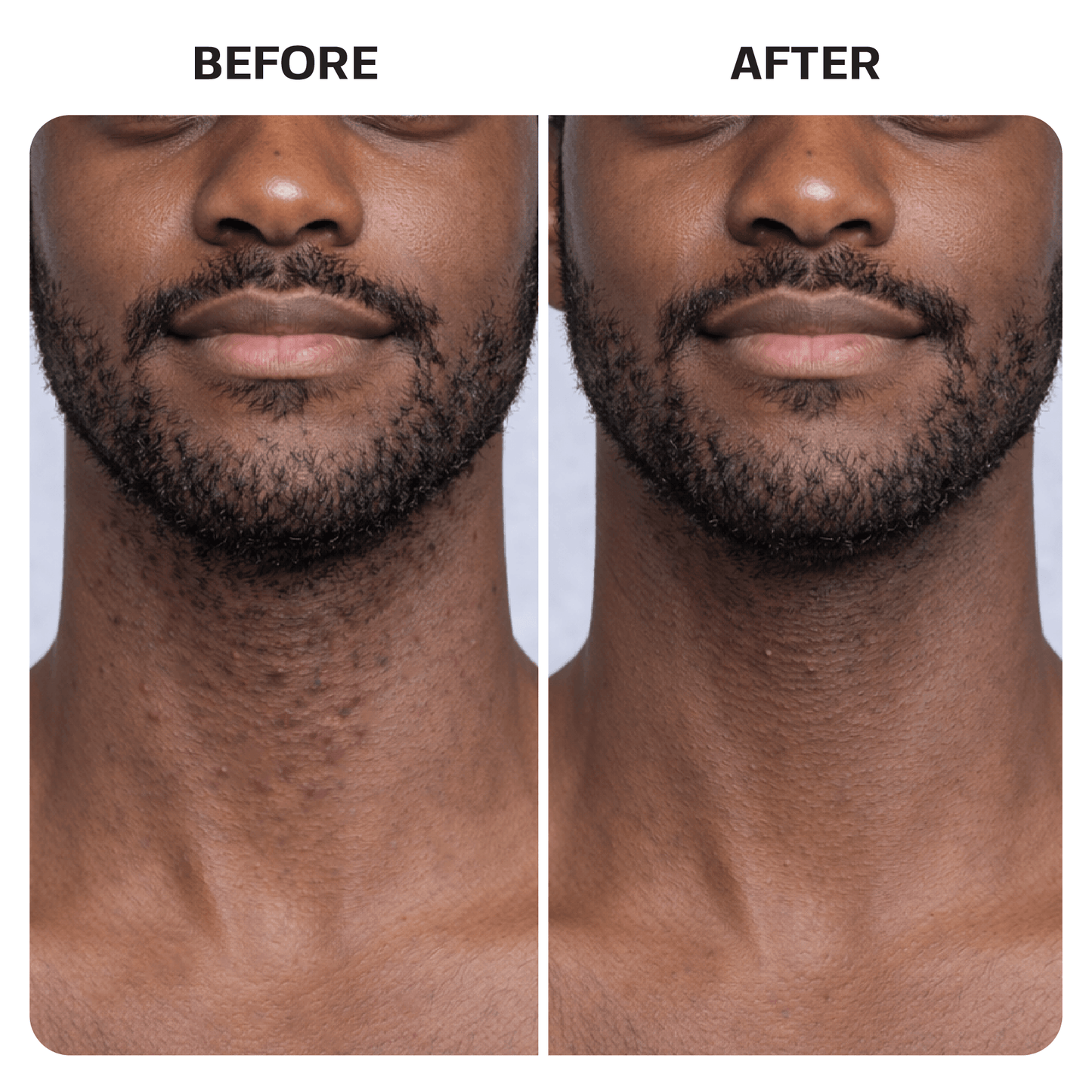 Ingrown Hair Roller Serum ingrown Base Laboratories 