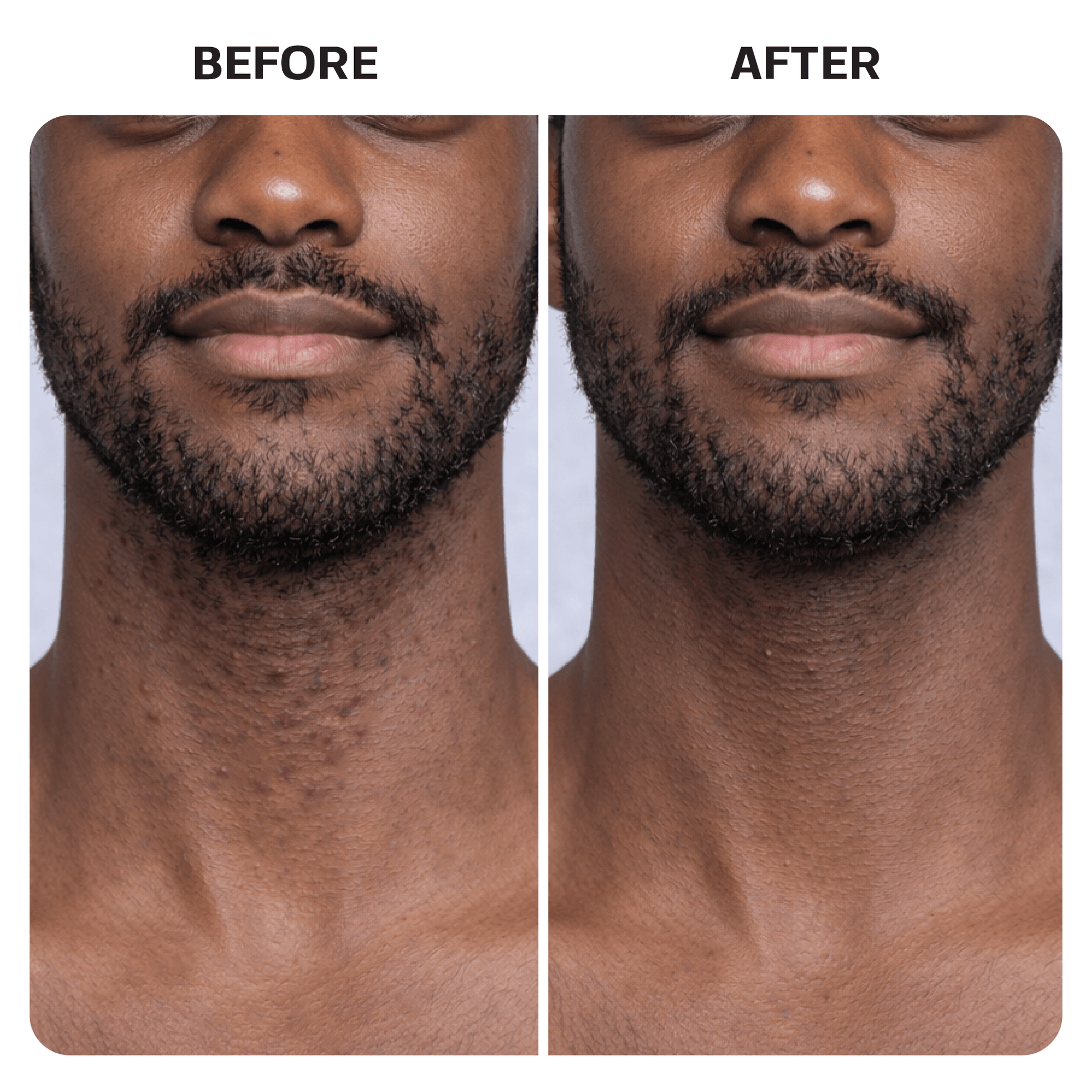 Ingrown Hair Roller Serum ingrown Base Laboratories 