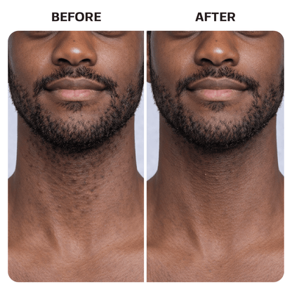 Ingrown Hair Roller Serum ingrown Base Laboratories 