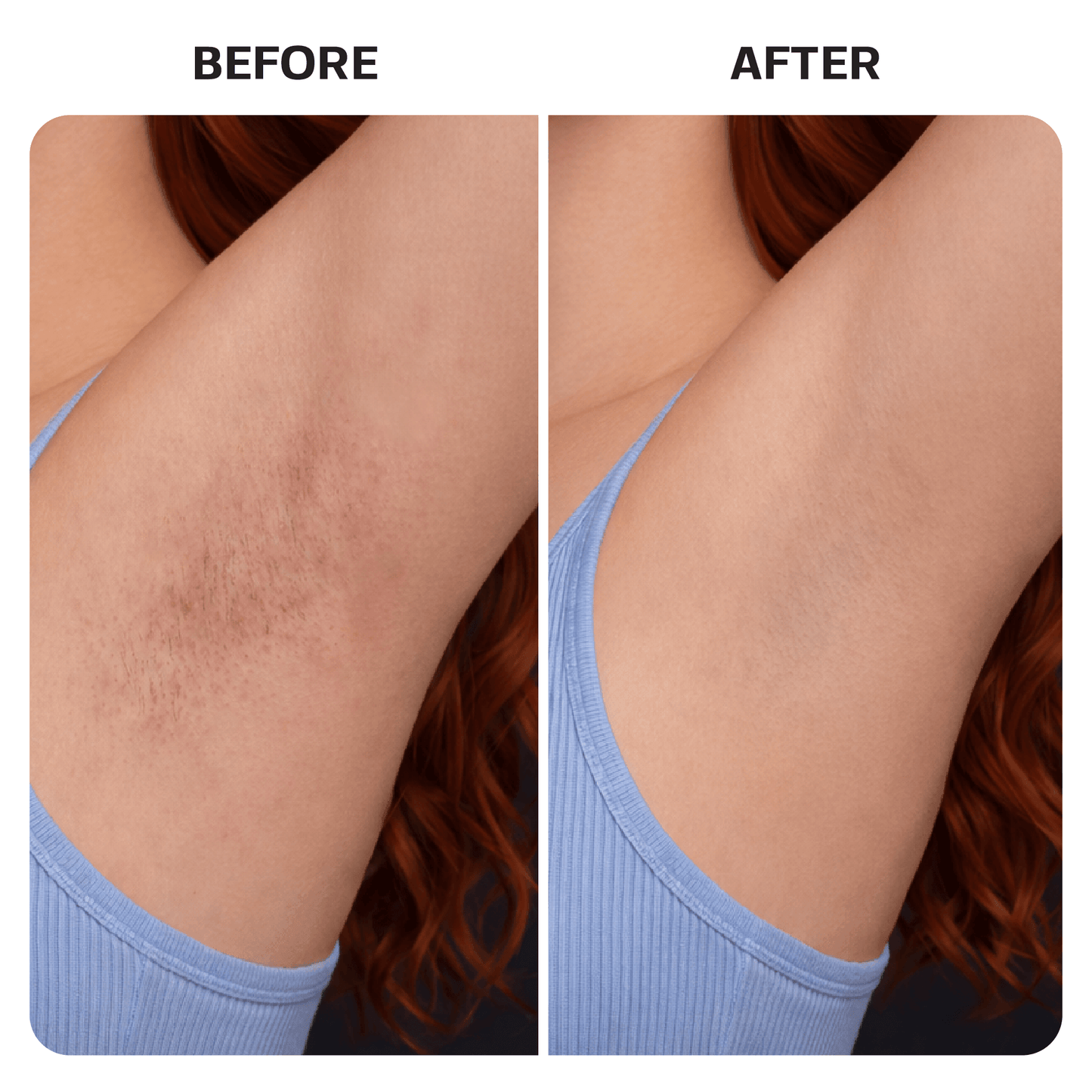 Ingrown Hair Treatment Pads ingrown Base Laboratories 