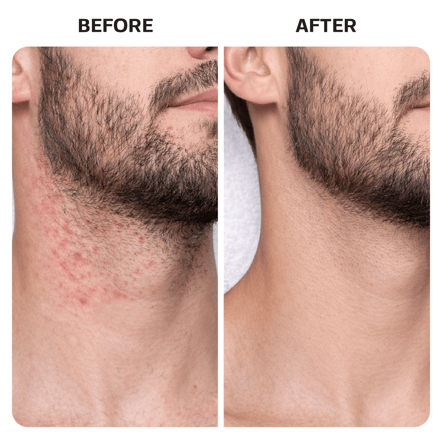 Ingrown Hair Treatment Pads ingrown Base Laboratories 