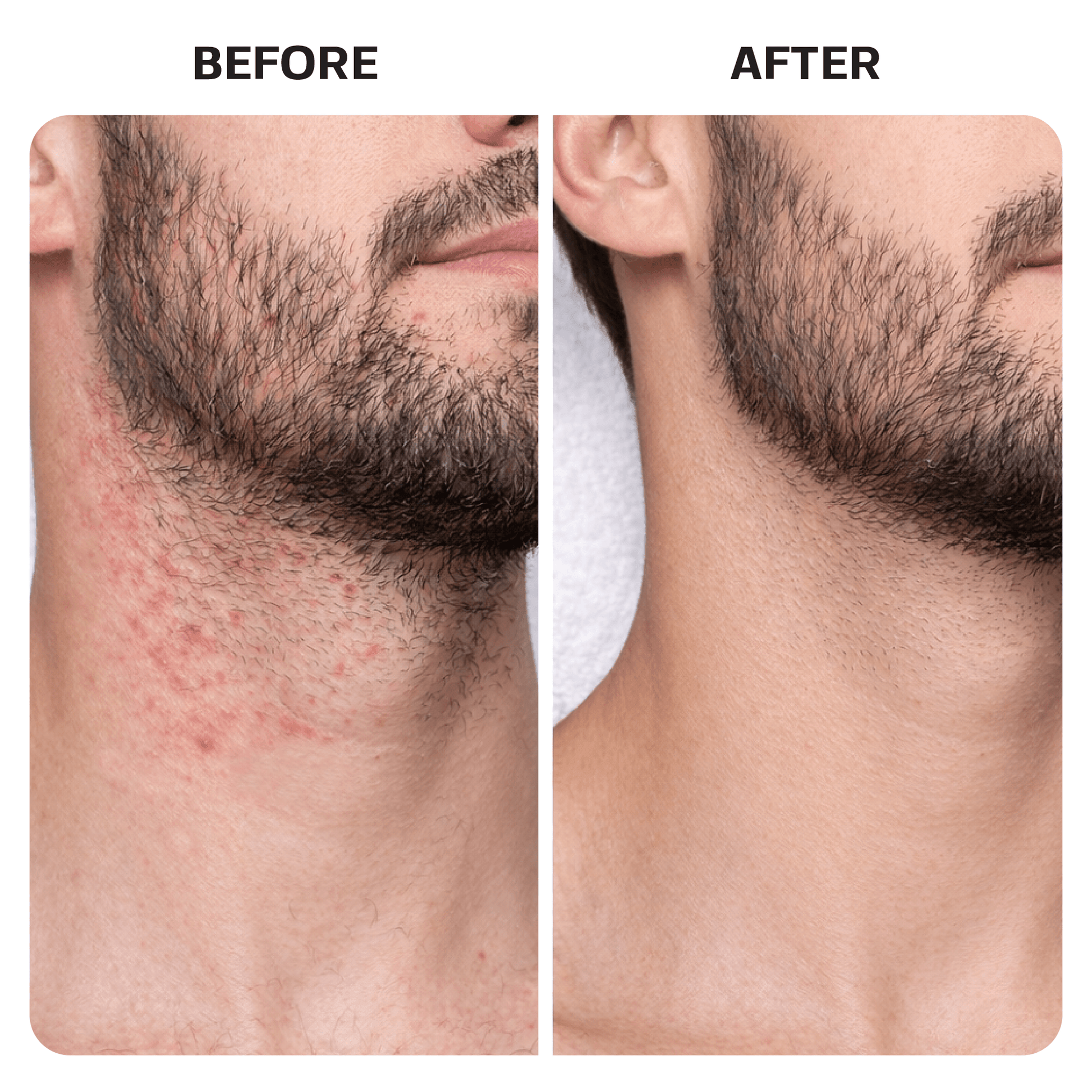 Ingrown Hair Treatment Pads ingrown Base Laboratories 