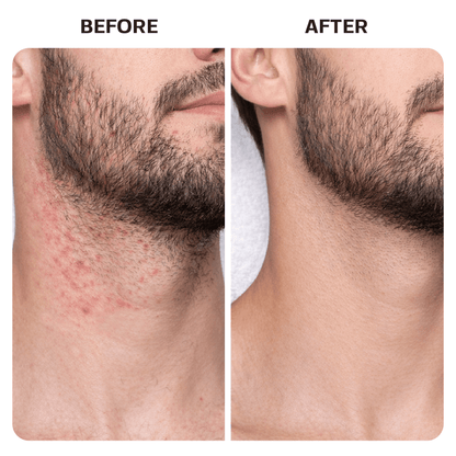 Ingrown Hair Treatment Pads ingrown Base Laboratories 