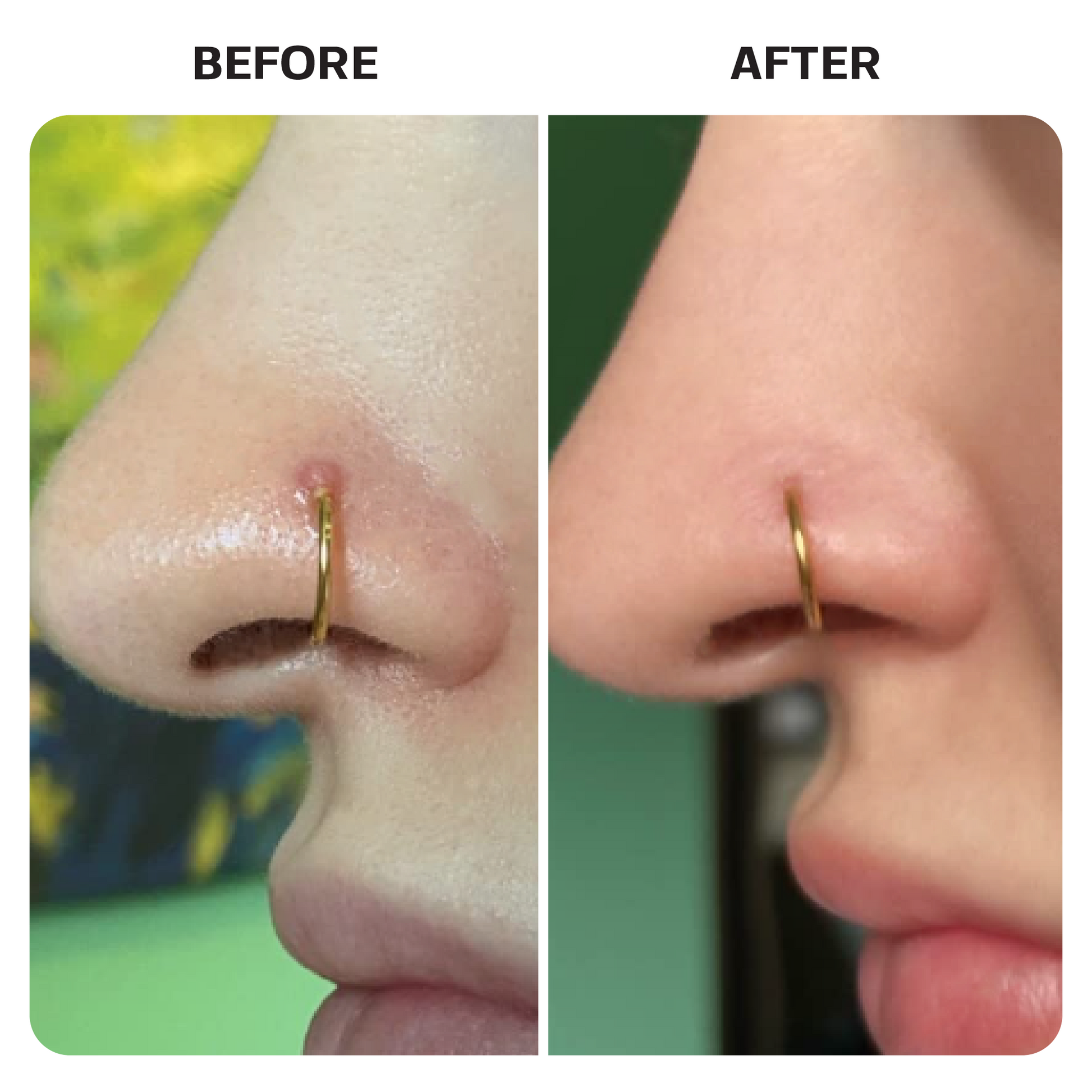 Keloid Bump Removal Gel Swabs Topical Base Laboratories 