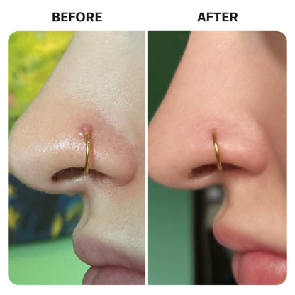 Keloid Bump Removal Gel Swabs Topical Base Laboratories 