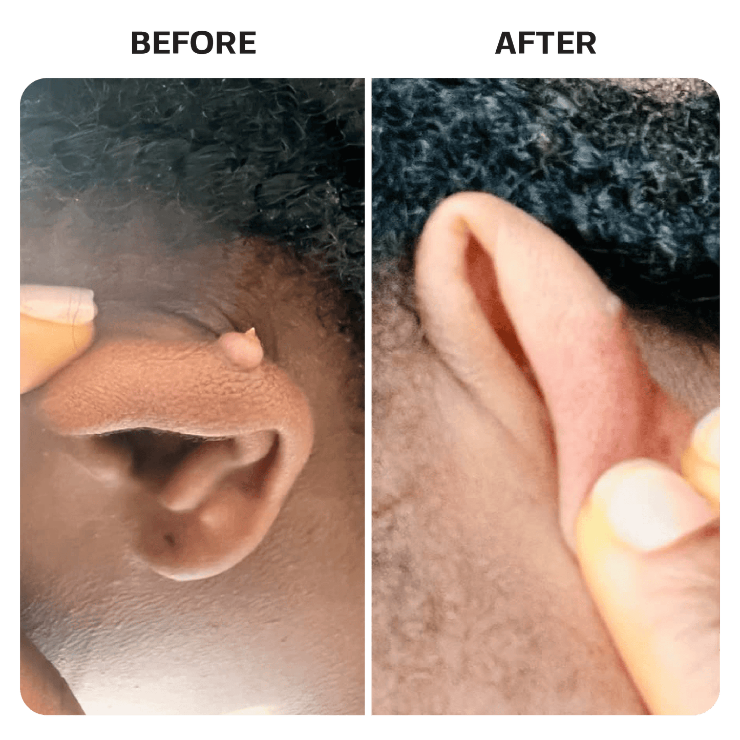 Keloid Bump Removal Gel Swabs Topical Base Laboratories 