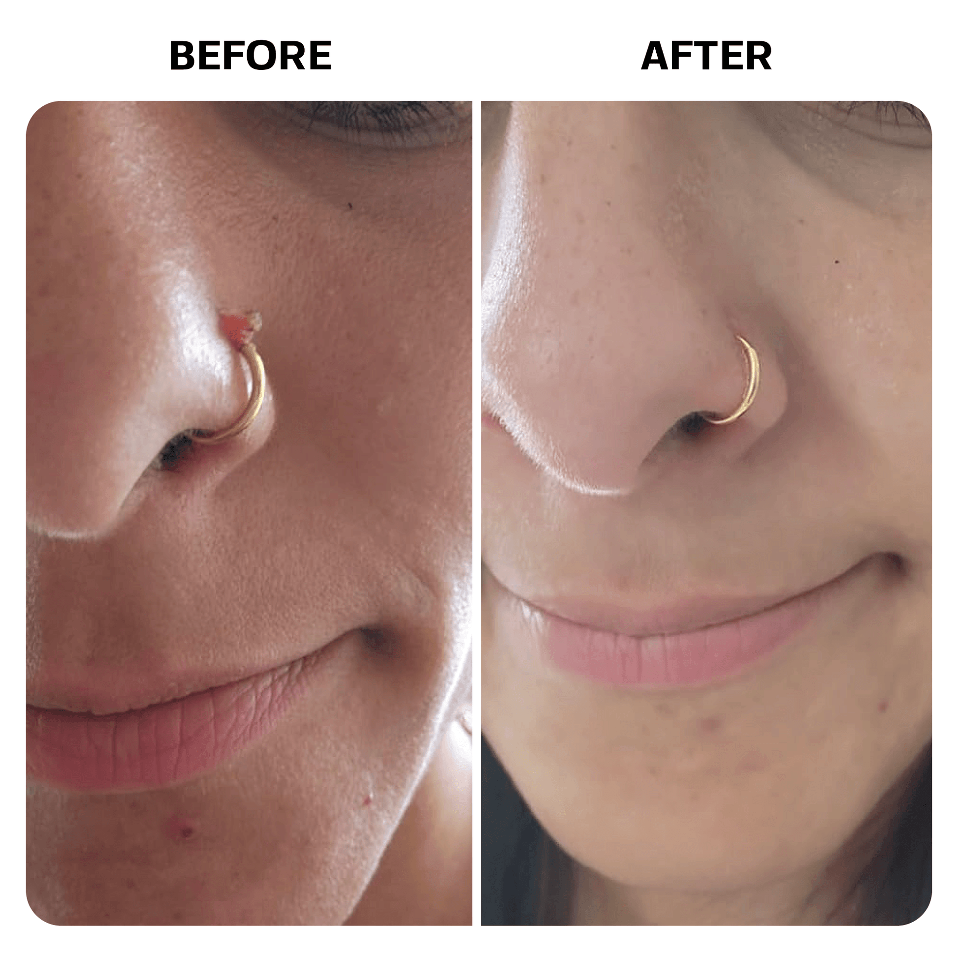Keloid Bump Removal Gel Topical Base Laboratories 