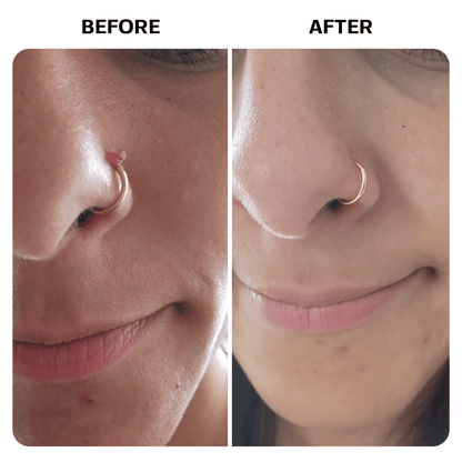 Keloid Bump Removal Gel Topical Base Laboratories 