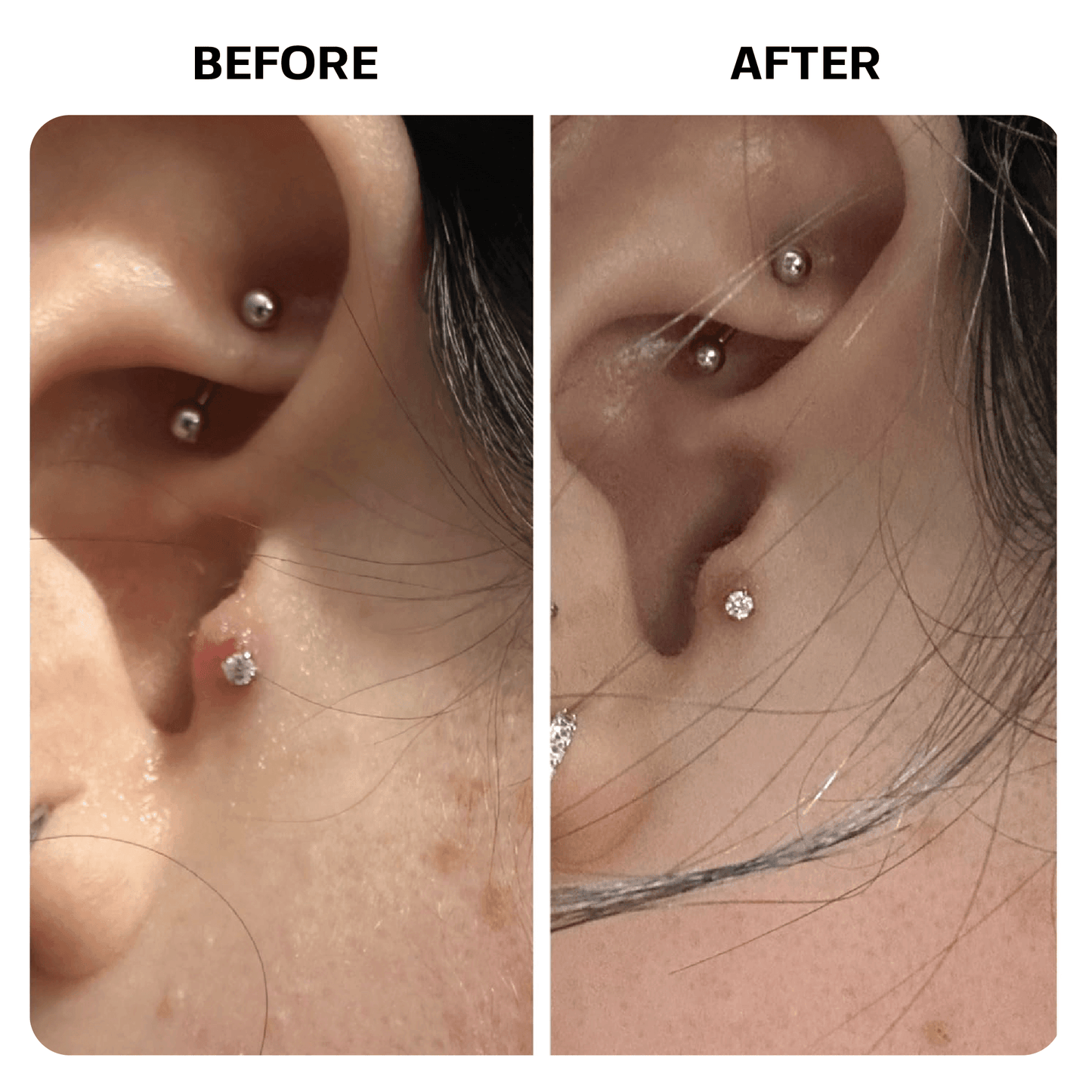 Keloid Bump Removal Gel Topical Base Laboratories 