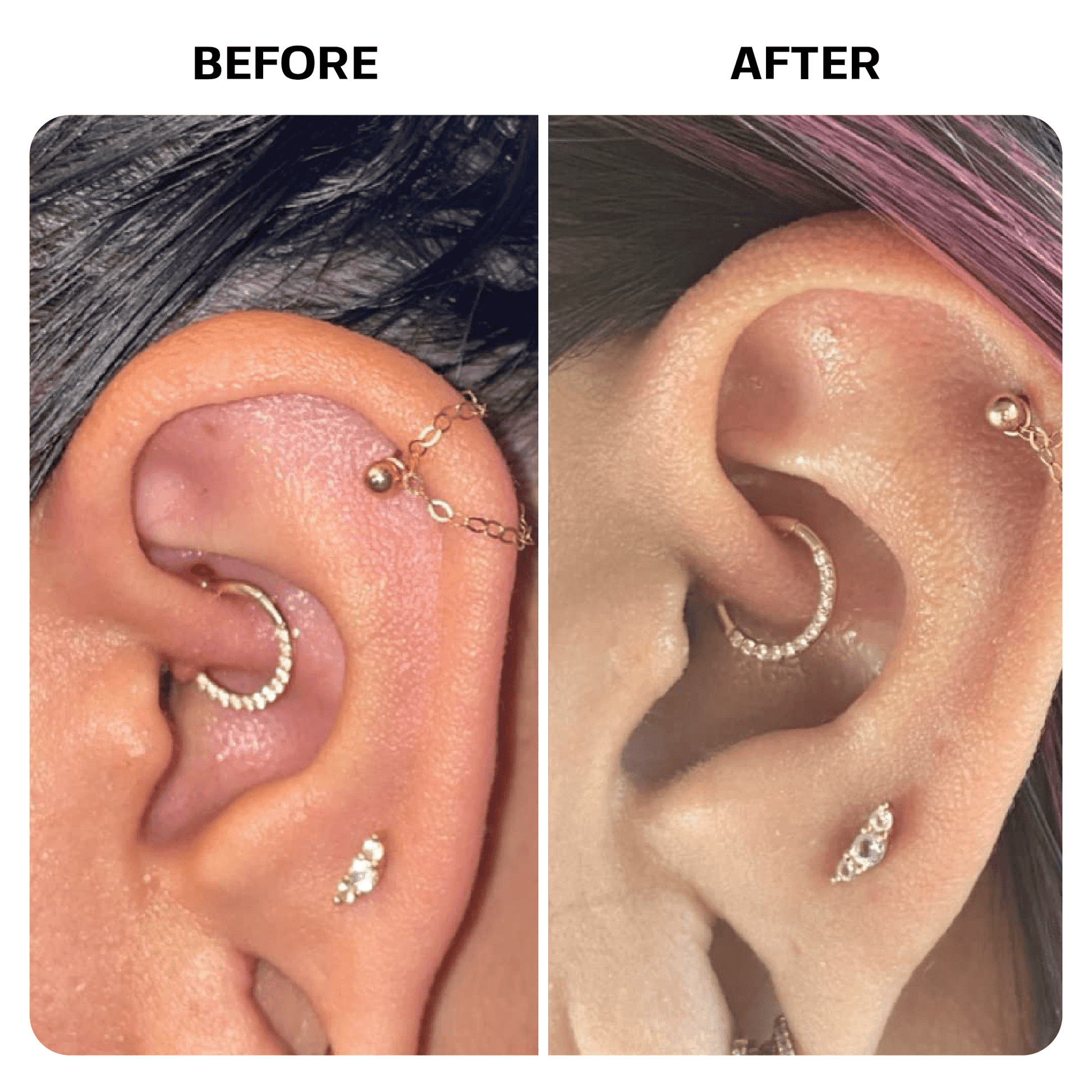 Keloid Bump Removal Gel Topical Base Laboratories 