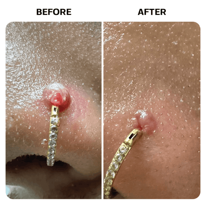 Keloid Bump Removal Gel Topical Base Laboratories 