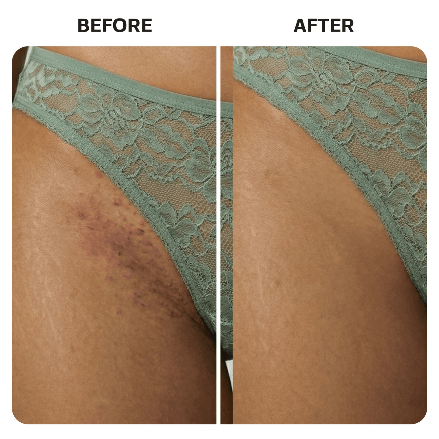 Ingrown Hair Treatment Oil