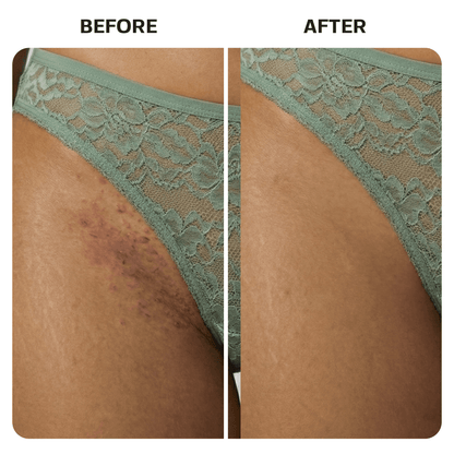 Ingrown Hair Treatment Oil