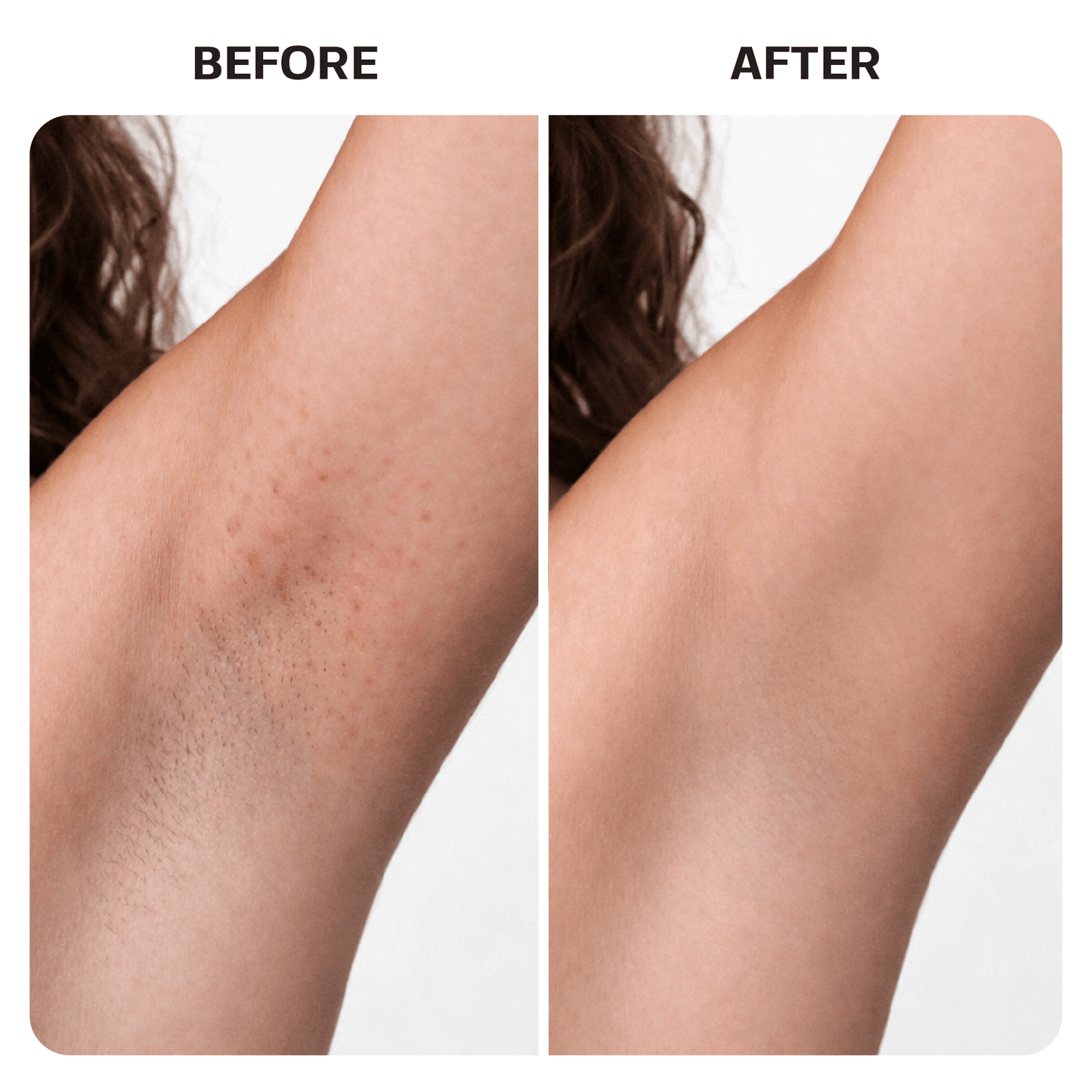 Ingrown Hair Treatment Oil