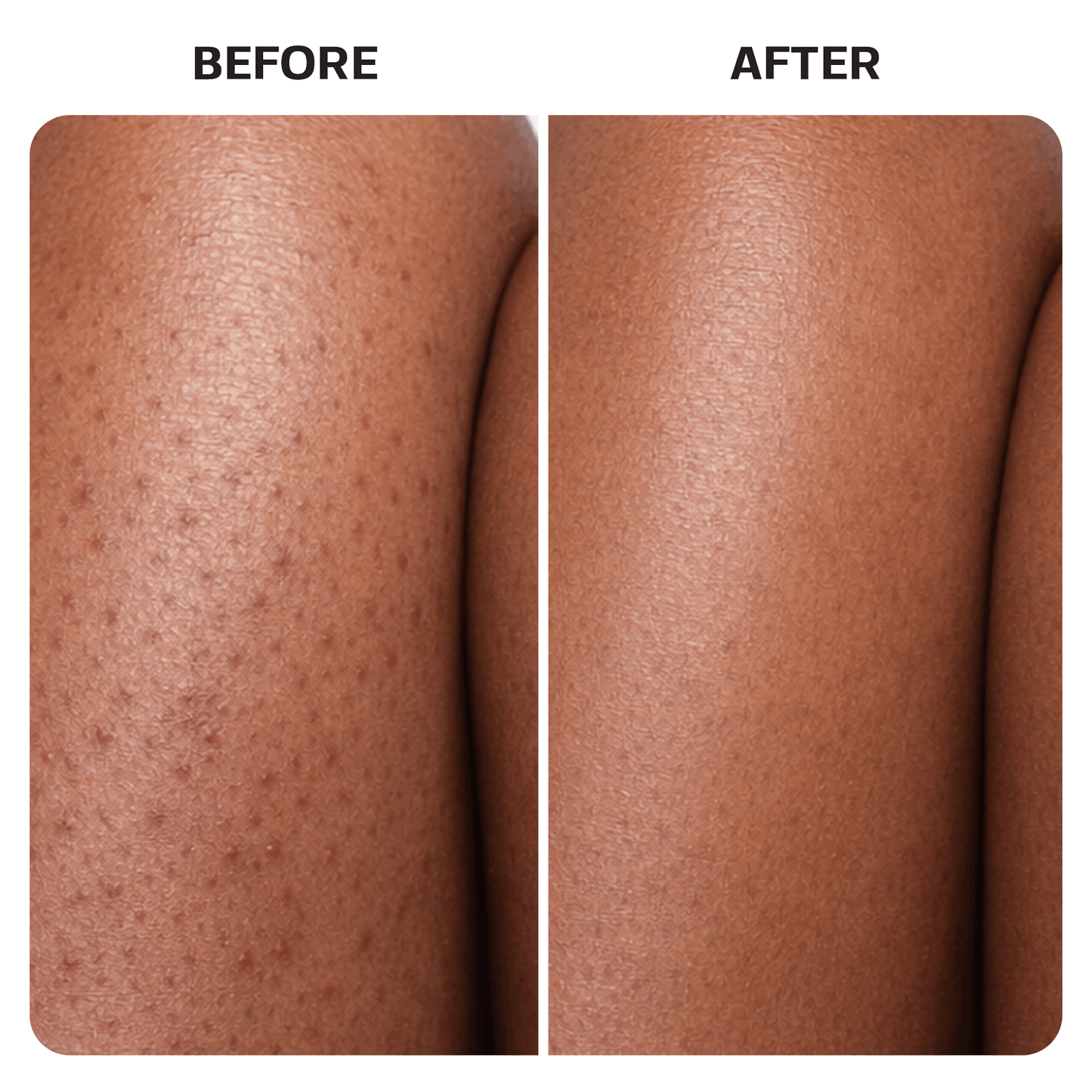 Ingrown Hair Treatment Oil